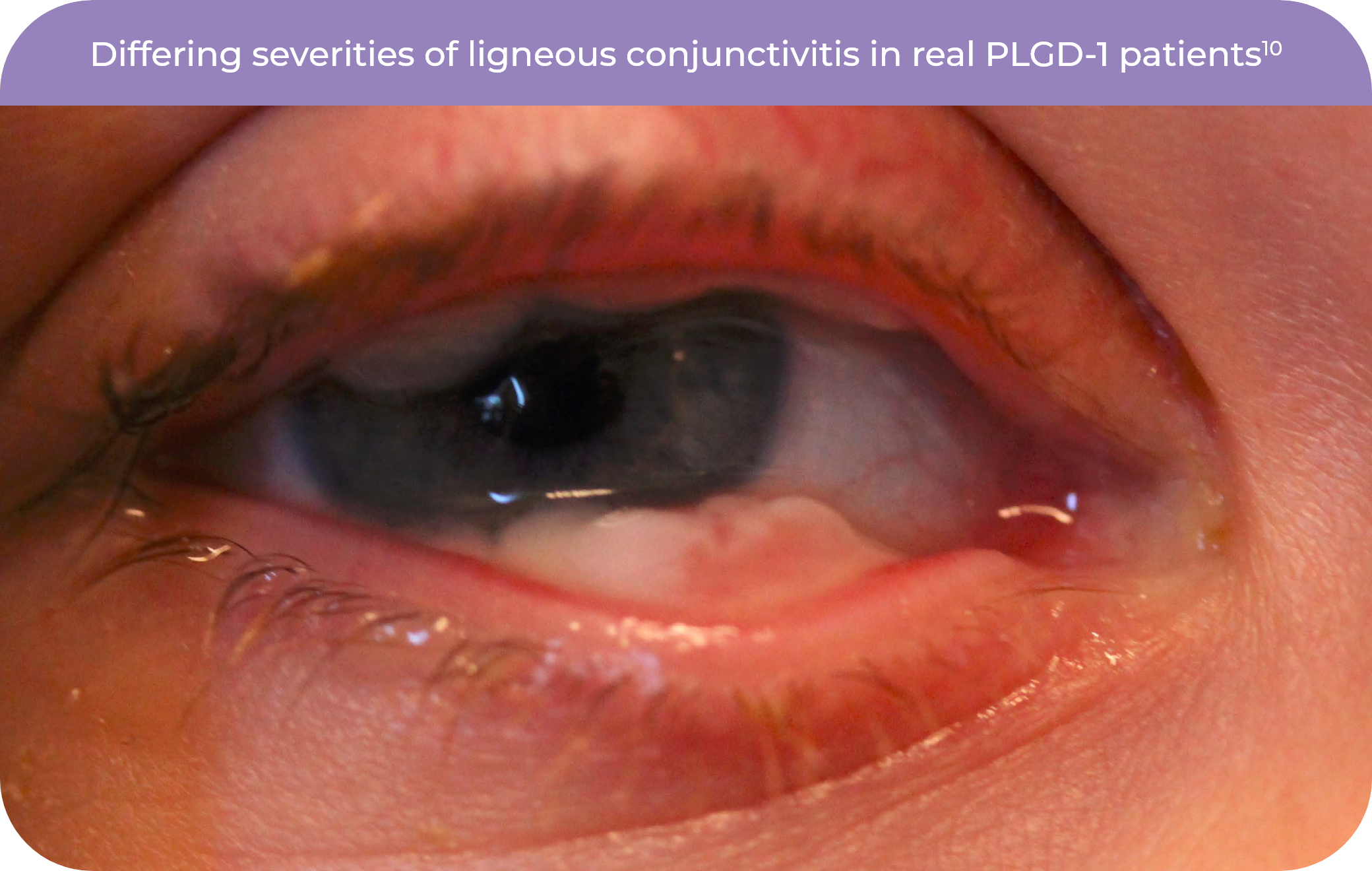Ligneous conjunctivitis gallery