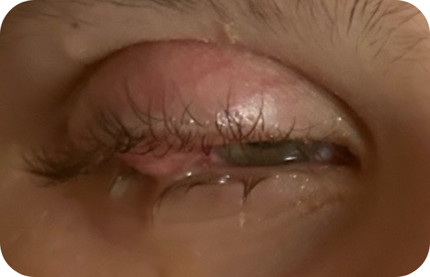 Ligneous conjunctivitis accompanied by swelling