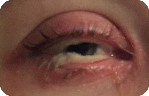 Ligneous conjunctivitis manifesting as a yellow discharge in the lower eyelid