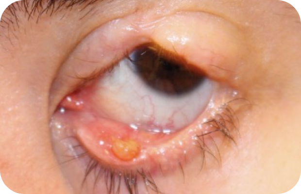 Ligneous conjunctivitis manifesting as lesions and swelling