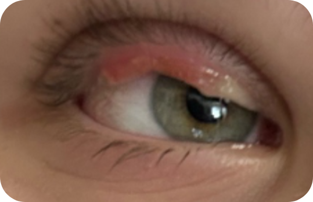 Ligneous conjunctivitis manifesting as upper eyelid swelling