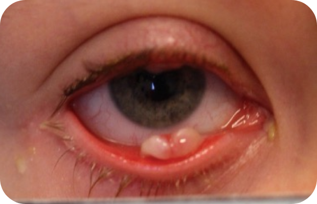 Ligneous conjunctivitis manifesting as white lesions in lower eyelid