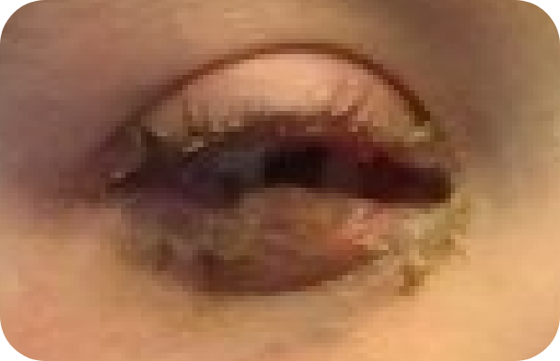 Ligneous conjunctivitis manifesting as wood-like growth under eye