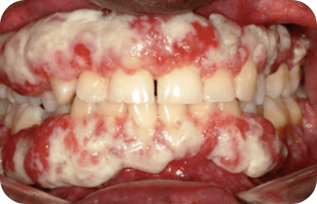 Ligneous gingivitis caused by congenital plasminogen deficiency type 1, manifesting as gum lesions