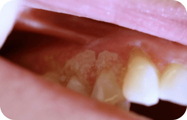 Ligneous gingivitis in the upper left mouth
