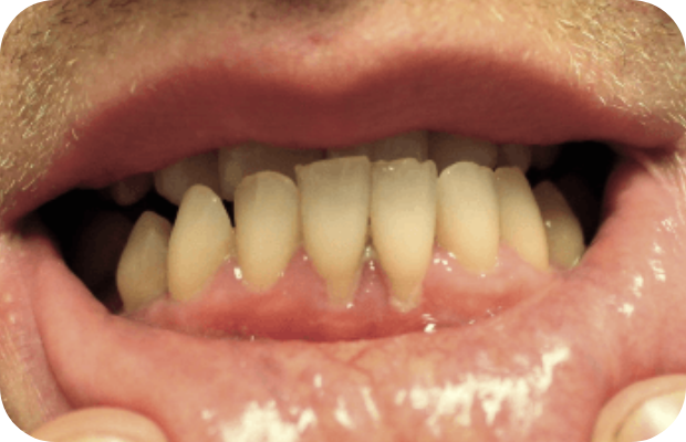 Ligneous gingivitis (periodontitis) with gingival enlargement
