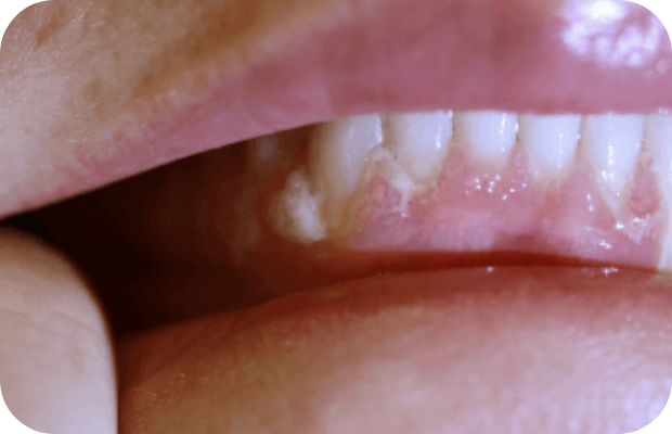 Ligneous periodontitis gum swelling