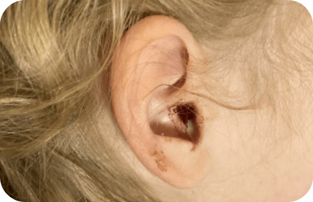 Otological lesions in plasminogen deficiency type 1 patient