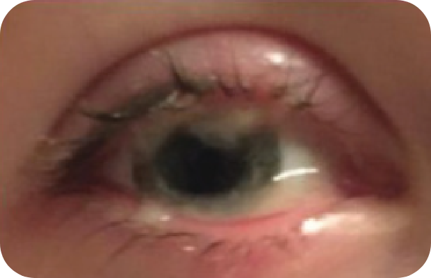 Pseudomembranous conjunctivitis caused by plasminogen deficiency type 1, with a watery and stringy appearance