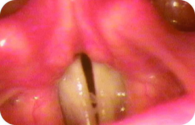 Respiratory tract lesions in plasminogen deficiency type 1 patient