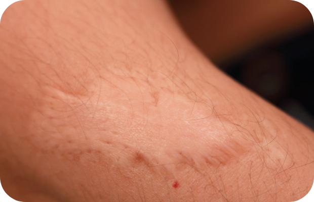 Skin lesions on arm