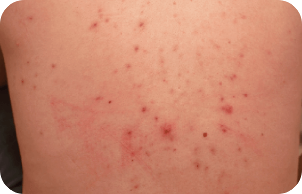 Skin lesions on back