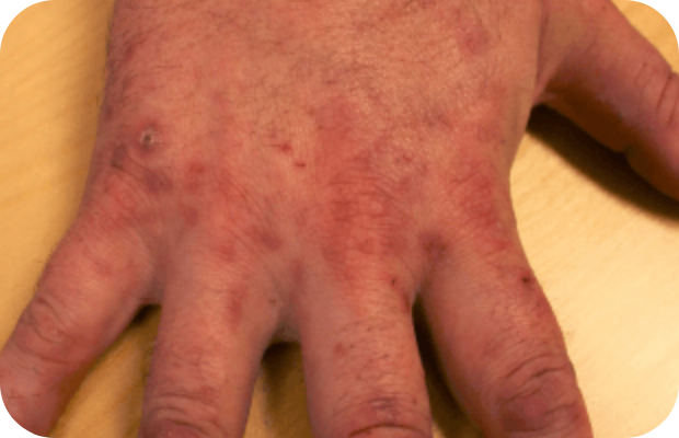 Skin lesions on hand