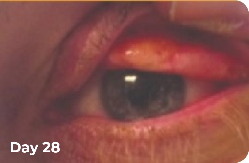 Photos of ligneous conjunctivitis after starting RYPLAZIM