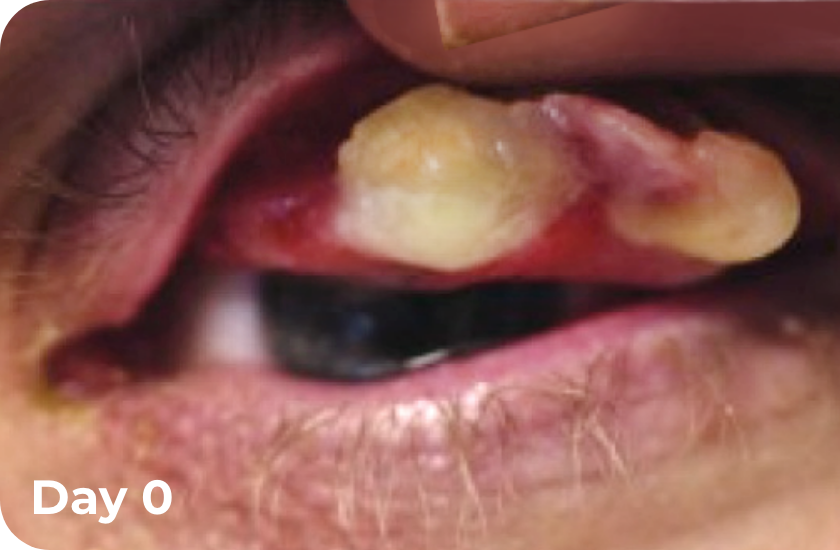 Photos of ligneous conjunctivitis before starting RYPLAZIM