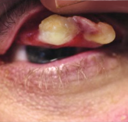 Ligneous conjunctivitis caused by congenital plasminogen deficiency type 1, manifesting as an eye lesion, prior to treatment with RYPLAZIM