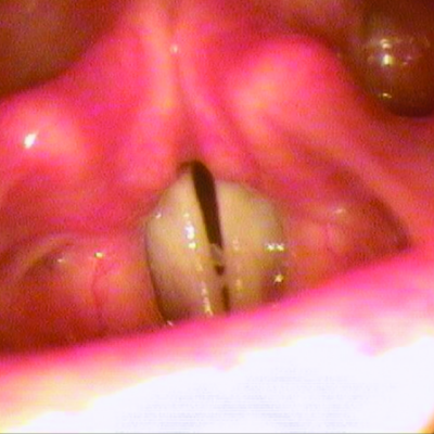 Respiratory tract lesions in plasminogen deficiency type 1 patient